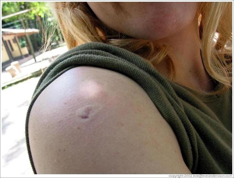 Eve's shoulder after being  bitten by macaw.